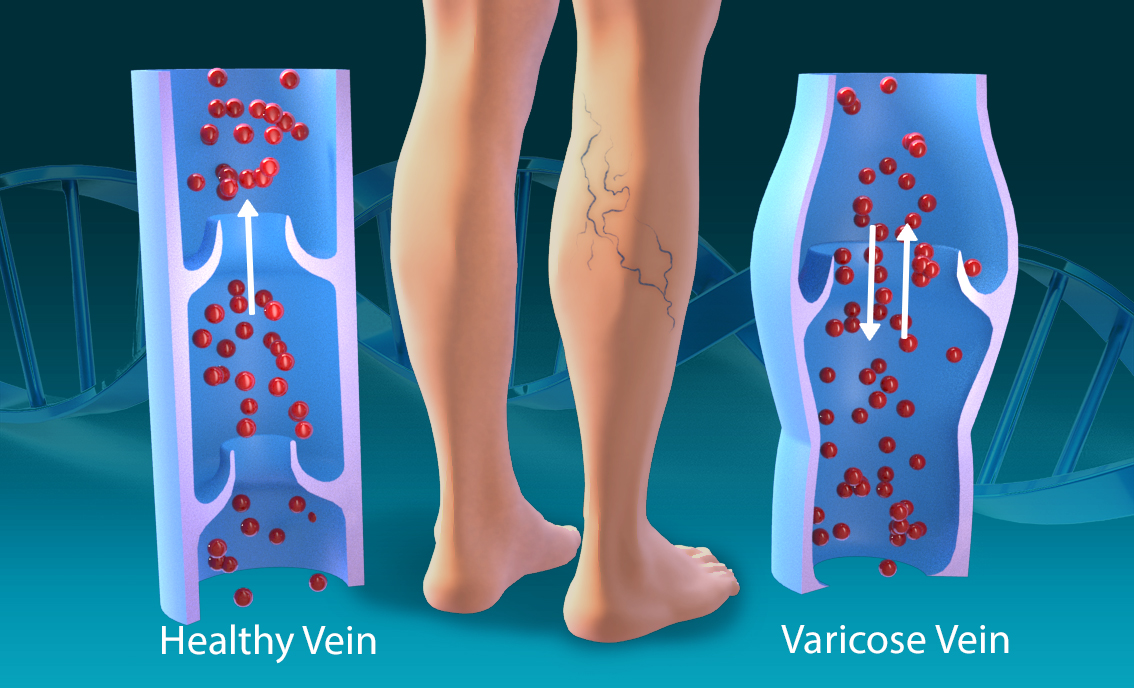 research study on varicose veins
