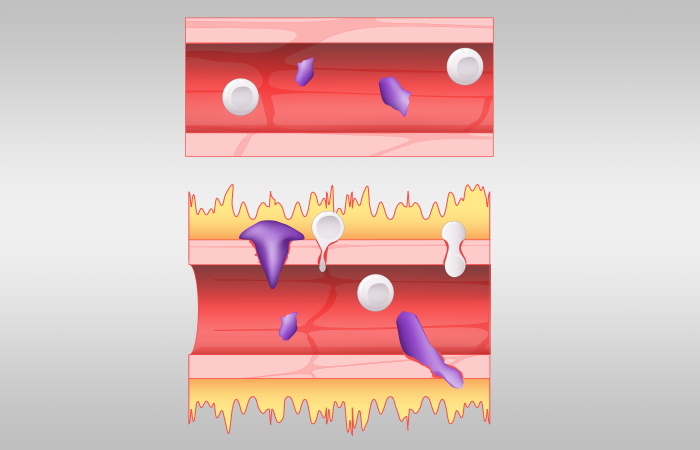 Analyses of lung fluid cells from COVID-19 patients conducted on the nation’s fastest supercomputer point to gene expression patterns that may explain the runaway symptoms produced by the body’s response to SARS-CoV-2. Credit: Jason B. Smith/ORNL, U.S. Dept. of Energy