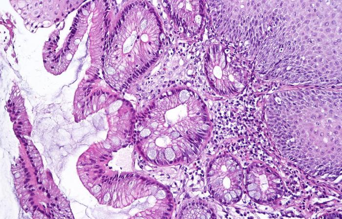 An illustration of a microscopic piece of the esophagus shows the abnormal tissue of Barrett's esophagus. Image: National Institute of Diabetes and Digestive and Kidney Diseases, National Institutes of Health