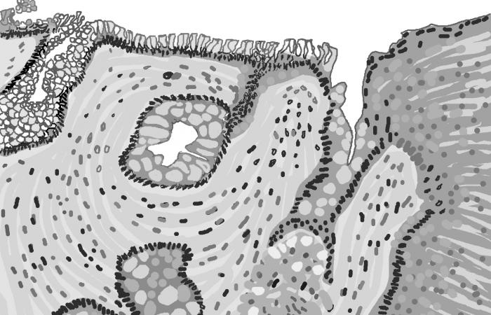 A black and white illustration of a microscopic piece of the esophagus shows the abnormal tissue of Barrett's esophagus. Image: National Institute of Diabetes and Digestive and Kidney Diseases, National Institutes of Health