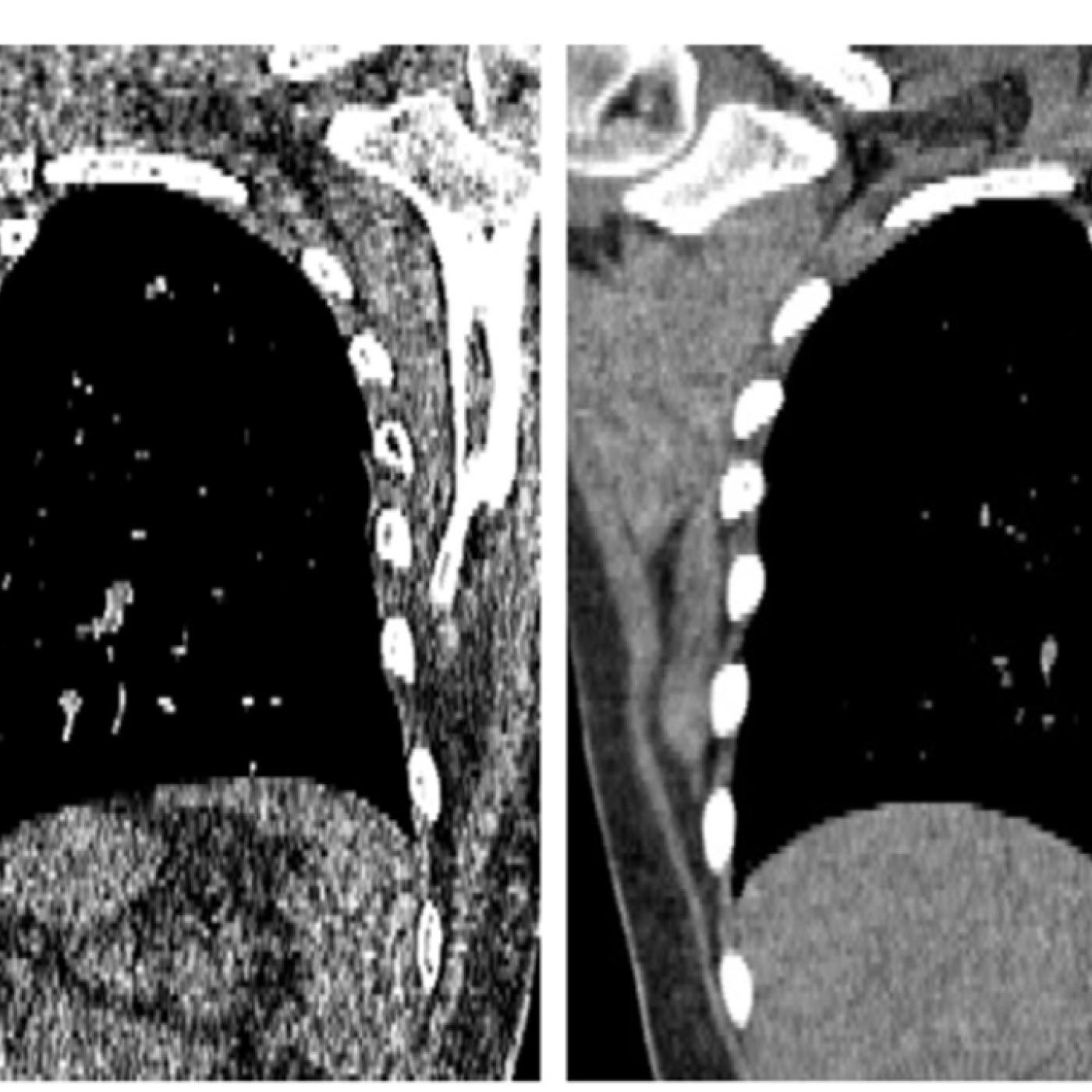 CT Scans