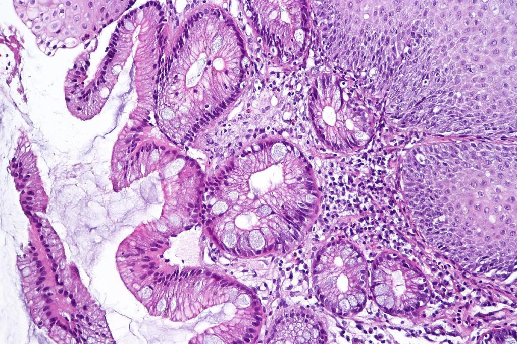 An illustration of a microscopic piece of the esophagus shows the abnormal tissue of Barrett’s esophagus. Image: National Institute of Diabetes and Digestive and Kidney Diseases, National Institutes of Health