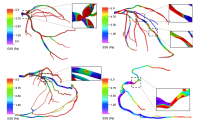 Endothelial shear stress in arterial geometries with different complex coronary lesions: (top left) bifurcation lesion (top right) serial lesion (bottom left) RCA vascular bed via collaterals (bottom right) ostial lesions. The inset marks the region of the stenosis. CSED Computational Sciences and Engineering ORNL