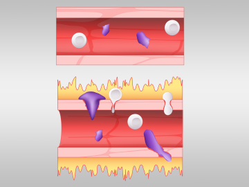 Analyses of lung fluid cells from COVID-19 patients conducted on the nation’s fastest supercomputer point to gene expression patterns that may explain the runaway symptoms produced by the body’s response to SARS-CoV-2. Credit: Jason B. Smith/ORNL, U.S. Dept. of Energy