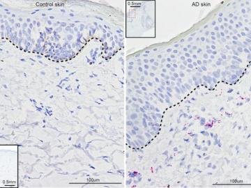 Genetic analysis revealed connections between inflammatory activity and development of atomic dermatitis, according to researchers from the UPenn School of Medicine, the Perelman School of Medicine, and Oak Ridge National Laboratory. Credit: Kang Ko/UPenn