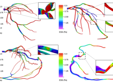 Endothelial shear stress in arterial geometries with different complex coronary lesions: (top left) bifurcation lesion (top right) serial lesion (bottom left) RCA vascular bed via collaterals (bottom right) ostial lesions. The inset marks the region of the stenosis. CSED Computational Sciences and Engineering ORNL