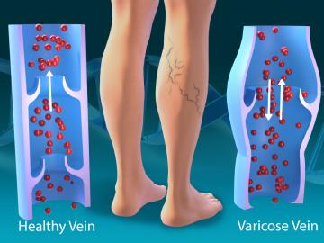 Computational systems biologists at ORNL worked with the U.S. Department of Veterans Affairs and other institutions to identify 139 locations across the human genome tied to risk factors for varicose veins, marking a first step in the development of new treatments. Credit: Andy Sproles/ORNL, U.S. Dept. of Energy