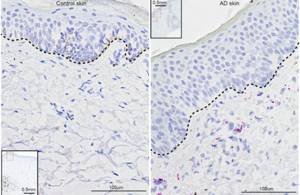 Genetic analysis revealed connections between inflammatory activity and development of atomic dermatitis, according to researchers from the UPenn School of Medicine, the Perelman School of Medicine, and Oak Ridge National Laboratory. Credit: Kang Ko/UPenn