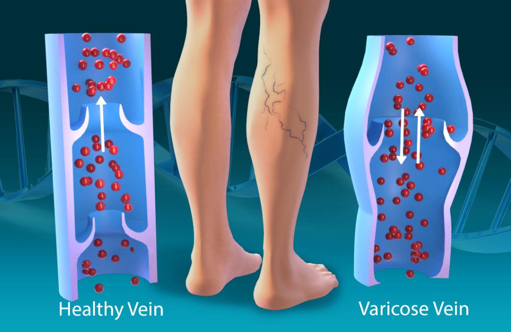 Computational systems biologists at ORNL worked with the U.S. Department of Veterans Affairs and other institutions to identify 139 locations across the human genome tied to risk factors for varicose veins, marking a first step in the development of new treatments. Credit: Andy Sproles/ORNL, U.S. Dept. of Energy