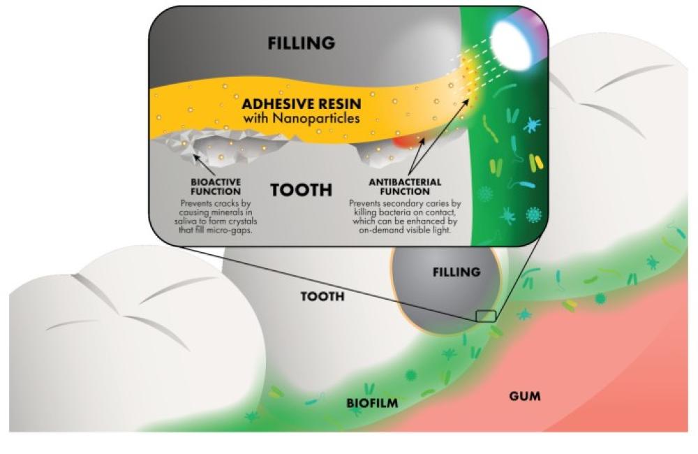 Illustration of a tooth cross-section showing a dental filling adhered with adhesive resin containing nanoparticles. The resin layer is highlighted in yellow, with labels indicating its bioactive function (preventing cracks by forming crystals in micro-gaps) and antibacterial function (killing bacteria on contact, enhanced by visible light). The surrounding gum tissue and biofilm are also depicted, emphasizing the protective properties of the adhesive.
